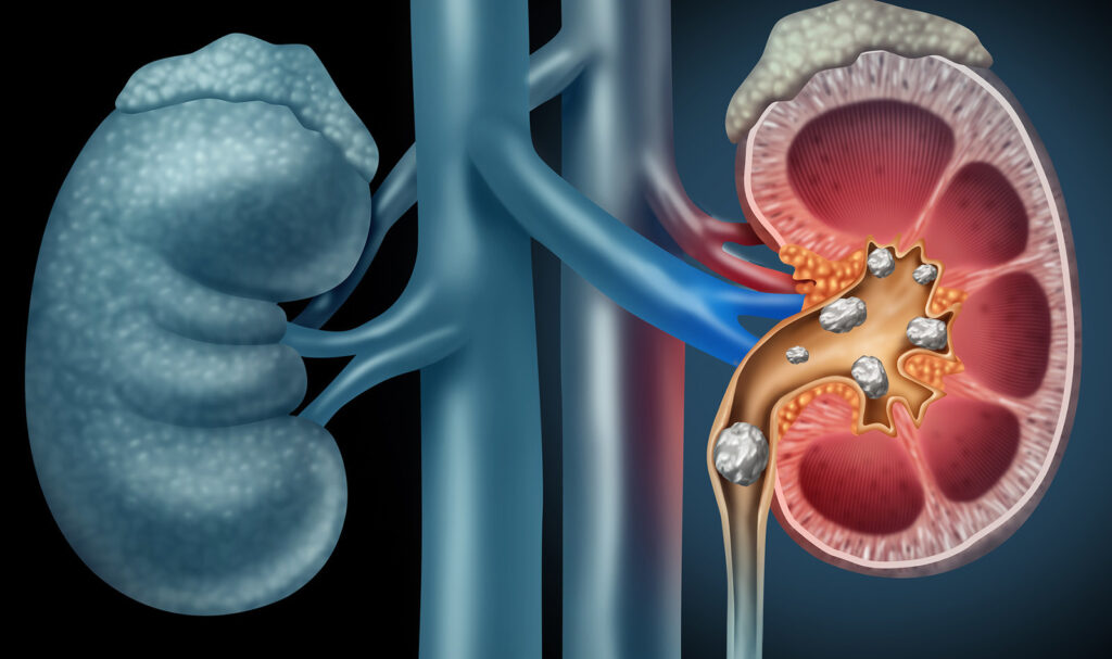 What is renal colic and its causes?