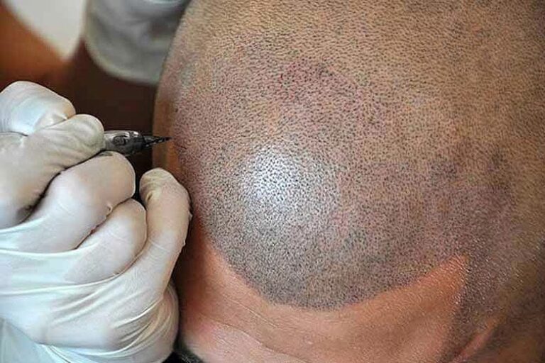 Scalp Micropigmentation in Las Vegas